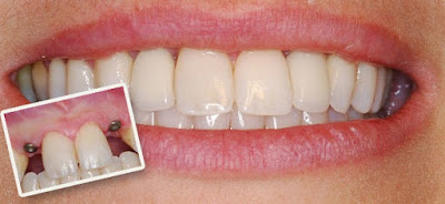 Trông răng implant tiêu chuẩn quốc tế là gì?