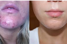 How To Remove Acne Scars In One Day - Is It Even Possible?