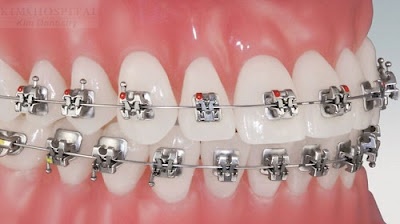 Các loại mắc cài niềng răng được chuyên gia nha khoa khuyên dùng 3