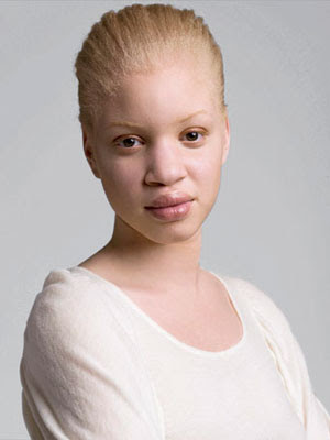 albino person portrayal