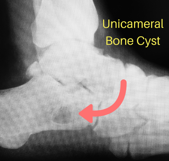 Unicameral Bone Cysts