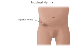 Hernia+Inguianlis