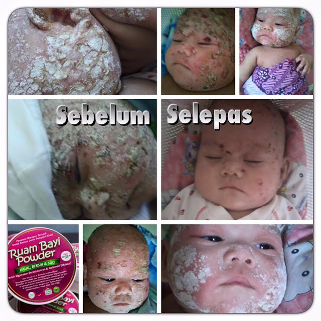 Ruam Bayi Powder - Merawat pelbagai jenis penyakit kulit 