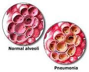 Askep Anak Pneumonia