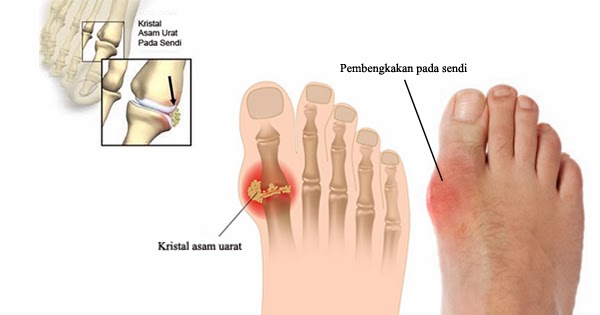 Obat Asam Urat Gejala Penyebab Pantangan Penderita Asam Urat