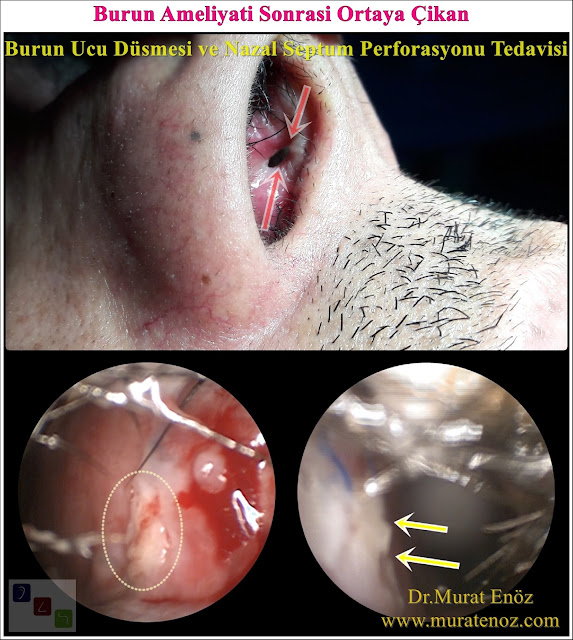 Nazal septum perforasyonu - Septum perforasyonu ameliyatı olanlar - Septum perforasyonu olanlar - Septum perforasyonu ameliyatı yapan doktorlar - Burunda delik oluşumu - Burun duvarında delik - Burun kıkırdak delinmesi tedavisi - Septum perforasyonu ameliyatı olanlar - Septum perforasyonu olanlar - Septal perforasyon tamiri - Septal buton uygulaması - Nazal septum perforasyonu tedavisi - Nazal septum perforasyonu nedenleri - Nazal septum perforasyonu belirtileri - Septum perforasyonun cerrahi onarımı - Burun delinmesinin nedenleri - Nazal septum perforasyonu tanısı - Erkek burun estetiği - Burun estetiği ameliyatı - Definition of Nasal Septal Perforation - Causes of Perforated Nasal Septum - Symptoms of Nasal Septal Perforation - Diagnosis of Nasal Septal Perforation - Surgical Treatment For Nasal Septal Perforation - Nasal Septal Perforation Repair - Surgical Repair of Nasal Septal Perforation - Burun Ucu Düşmesi