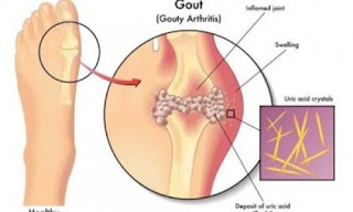 Asam urat dan herbal, super kecetit asam urat, penyebab asam urat pada ibu hamil, efek asam urat naik, pantangan asam urat kolesterol dan diabetes, cara menyembuhkan asam urat yang kambuh, herbal asam urat tinggi, apakah asam urat bisa sembuh tanpa obat, apa obat asam urat yang paling bagus, obat asam urat alami ketan hitam, mengobati asam urat dengan sambiloto