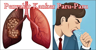 Penyakit Kanker Paru paru