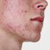 A Look at Laser Acne Treatment
