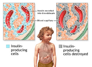 diabetes melitus,diabetes,blood sugar