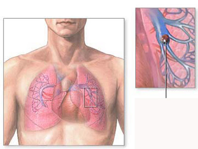 Xơ phổi, nguyên nhân, triệu chứng và cách trị
