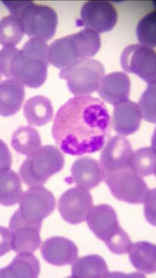 Imagen de un Eosinófilo -Valores Normales de Leucocitos