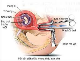 phá thai an toàn