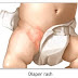 Pediatric Nursing Care Plan for Diaper Rash