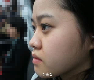 짱이뻐! - I Had Nose Job Plastic Surgery At Wonjin Plastic Surgery