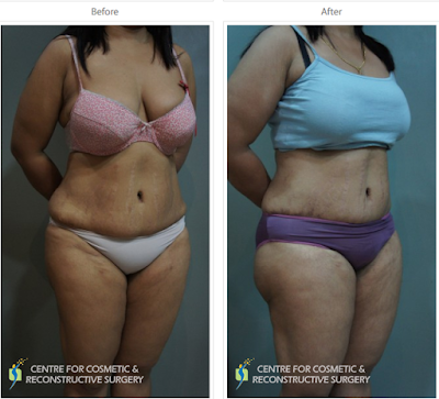 Liposuction in Mumbai