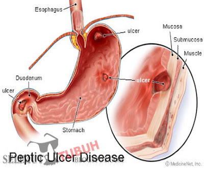 Selimut Tubuh: Gastrik, Sesak nafas Dan ubat