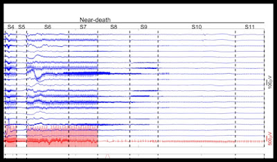 EEG of dying patient