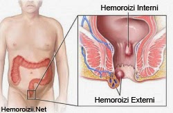 Tratament Pentru Hemoroizi Hemoroizi Interni