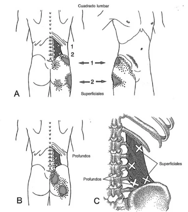 Músculo del cuadrado lumbar  - Silencio Neural