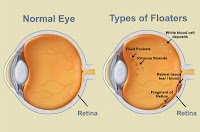 masalah floaters,atasi masalah floaters,atasi floaters,floaters,apa itu floaters