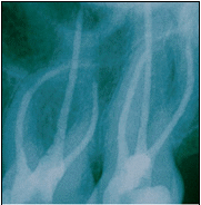 alat kedokteran gigi endodontik