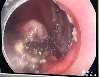 endoscopic submucosal dissection