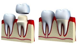 Tại sao nên bọc răng sứ thẩm mỹ ?