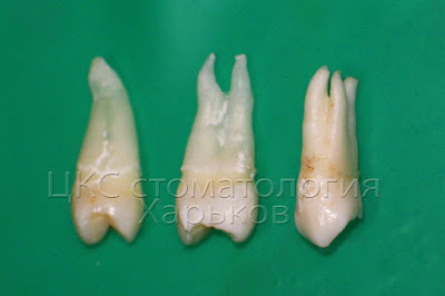 Один, два или три корня у верхнего премоляра
