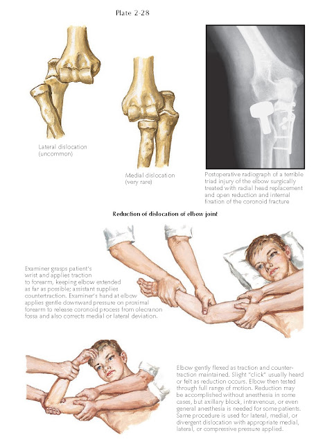 Reduction of dislocation of elbow joint