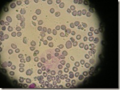 macrocytic anaemia hematology slide photograph