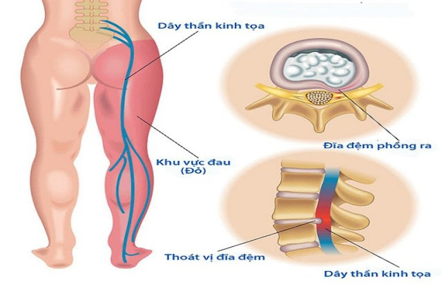 Giải phẫu đau thần kinh tọa có được không?