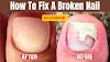 3 Ways To Treat A Torn Toenail | How To Fix A Torn Toenail | How To Fix A Broken Nail | Toenail Ripped Off How To Treat