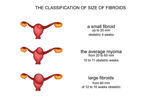 UTERINE FIBROID? CAUSES, SYMPTOMS, FIBROIDS CANCER?  WHICH SIZE IS DANGEROUS?  TYPES, COMPLICATIONS, FIBROIDS PREGNANCY, TREATMENT