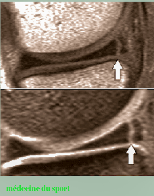 IMAGERIE DU GENOU APPLIQUÉE A LA PATHOLOGIE SPORTIVE