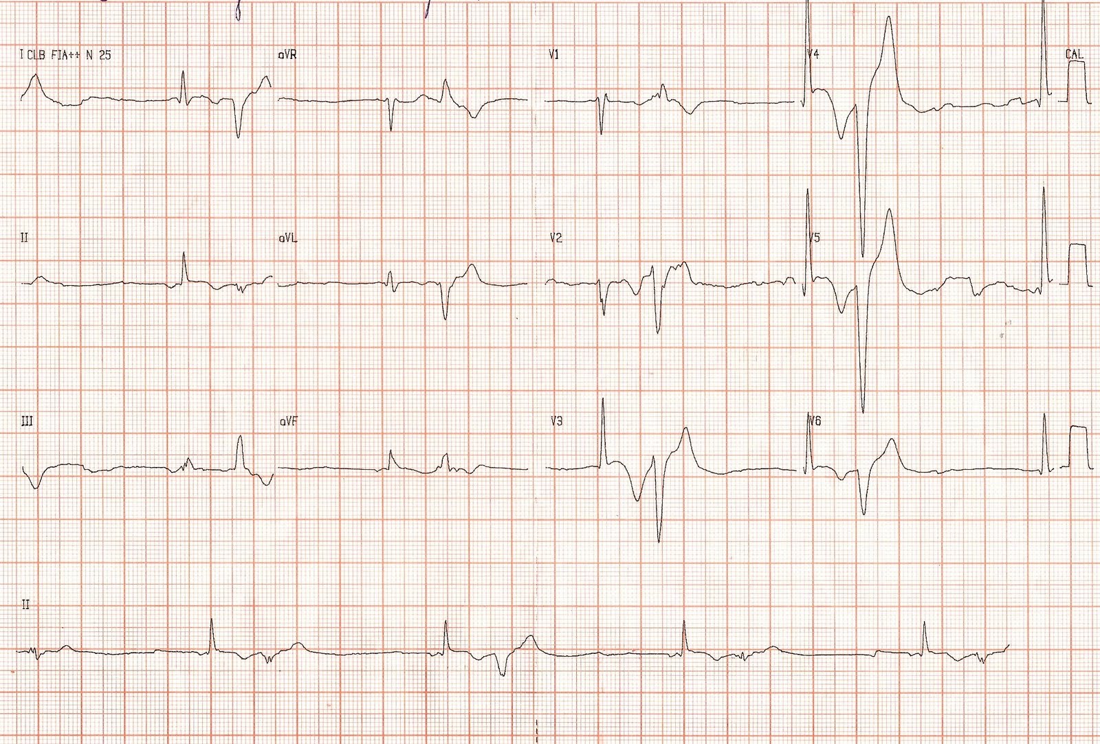 Blog de Eletrocardiografia: 2010