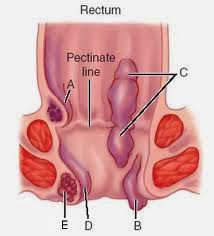 Gambar Untuk Penyakit Ambeien Atau Wasir