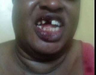 Omg! Man knocks off wife's teeth for refusing to abort pregnancy (PHOTOS)