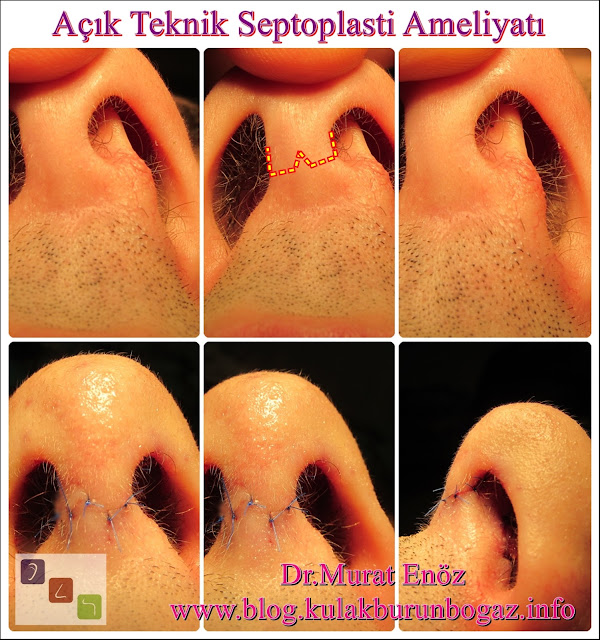 Treatment of caudal septum deviation - Caudal septoplasty - Open technique septoplasty