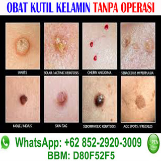 Obat Kutil Kelamin, TLP/LINE/WA: 085229203009, BBM: D80F52F5, Pengobatan Kutil Kelamin, Benjolan Bintik Bintil Daging Tumbuh Kutil Di Alat Kemaluan Kelamin, Obat Kutil Paling Ampuh, Obat Kutil, http://obat-kelamin.com/ Cara & Tips Menghilangkan Kutil Kelamin Paling Ampuh, Obat Kutil Kelamin Herbal, Obat Kutil Kelamin Tradisional, Obat Kutil Kelamin Alami, Obat Kutil Kelamin Pria Wanita (Penis, Vagina, Dubur Anus, Selangkangan Paha) Obat Kutil Kelamin Di Apotik Dokter, Obat Kutil Terbaik Terbukti Aman Tanpa Efek Samping Serta Terpercaya, Salep Krim Oles, 100% Terbukti, Terampuh Terbaik & Terpercaya, Ampuh, Manjur, Mujarab, Kumpulan obat kutil, pengobatan kutil kelamin, Pengobatan Kutil Kelamin Di Apotik/Dokter: miquimod podofilox podophyllin trichloroacetic acid bichloroacetic acid Condylox Fluorouracil interferon Krioterapi Elektrokauter Bedah Laser Operasi