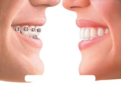 Niềng răng hoàn toàn không có hại cho sức khỏe