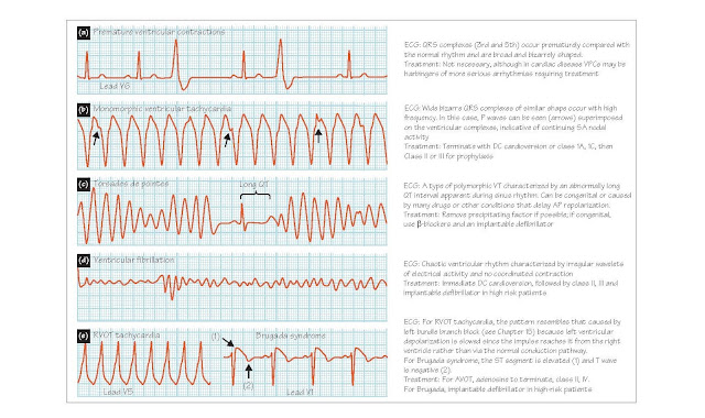 Ventricular Tachyarrhythmias And Nonpharmacological Treatment Of Arrhythmias, Ventricular tachycardia, Torsade de pointes, Ventricular fibrillation, Radiofrequency catheter ablation, Implantable defibrillators, Electronic pacemakers, 