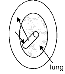 open pneumothorax