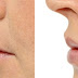 Địa chỉ làm đầy môi, môi mỏng ở đâu tốt?