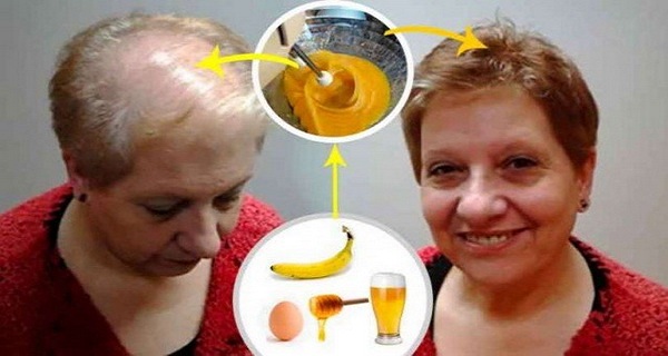 A Recipe Against Baldness In 2 Days Your Hair Begins To Grow Back