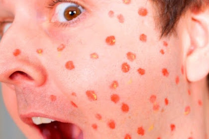 7 Effective Home Remedies To Treat Chicken Pox In Teens 