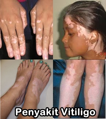 Obat Alami Vitiligo Tradisional