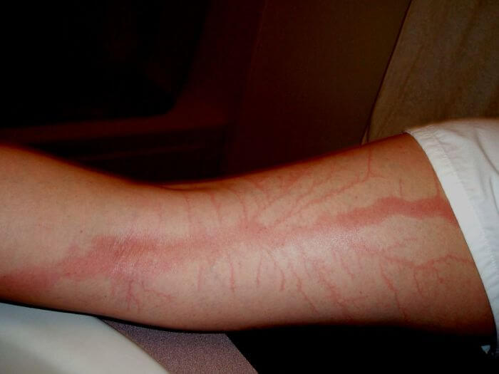 18 Lightning Strike Survivors Reveal Their Shocking Markings