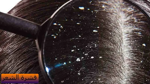 مع قدوم الشتاء ..كيف تحمين فروة شعرك من القشرة ..وكيف تعالجين الأنواع المختلفة من قشرة الشعر؟