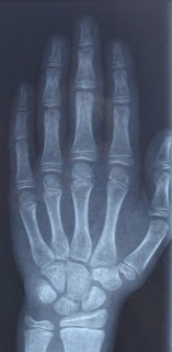 Erkek çocuk elinin röntgeni.